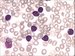 Infiltration of lymphoblasts, some of them with nuclear indentation, smear cell on the left. / Infiltrace lymfoblasty, nkter z nich se zezem v jde, jadern stn vlevo.