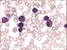 Infiltration of lymphoblasts, two of them with nuclear indentation, two eosinophiles, smear cell on the left. / Infiltrace lymfoblasty, dva z nich se zezem v jde, dva eozinofily, jadern stn vlevo.