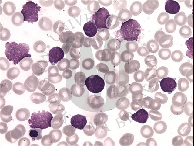 Chronic myeloid leukaemia, blast phase- BM