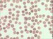 Plasmodium vivax causes benign tertian malaria. Erythrocytes are enlarged, in some of them Schffner dots are present. In the centre of the picture gametocyte is present.
 / Plasmodium vivax je pvodcem benign tdenn horeky. Napaden krvinka se zvtuje a asto obsahuje Schfnerovo tekovn. Gametocyt uprosted.