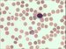 Plasmodium vivax causes benign tertian malaria. Erythrocytes are enlarged, in some of them Schffner dots are present. In the centre of the picture gametocyte is present.
 / Plasmodium vivax je pvodcem benign tdenn horeky. Napaden krvinka se zvtuje, asto je ovln na okrajch s vbky a asto obsahuje Schfnerovo tekovn. Gametocyt uprosted.