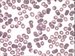 Plasmodium vivax causes benign tertian malaria. Erythrocytes are enlarged, in some of them Schffner dots are present. In the centre of the picture gametocyte is present.
 / Plasmodium vivax je pvodcem benign tdenn horeky. Napaden krvinka se zvtuje, asto je ovln na okrajch s vbky a asto obsahuje Schfnerovo tekovn. Gametocyt uprosted.