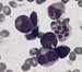 There is the giant metamyelocyte at 6 o'clock at a typical change in granulocytic lineage. It is approximately twice times the size of a normal metamyelocyte with abnormal shape of nuclei. There is a hypersegmented neutrophil at right.     / Na 6. hodin je gigantick metamyelocyt jako typick zmna v granulocytrn ad. Je piblin dvakrt vt neli normln metamyelocyt s abnormlnm tvarem jdra. Vpravo je hypersegmentovan neutrofil. 