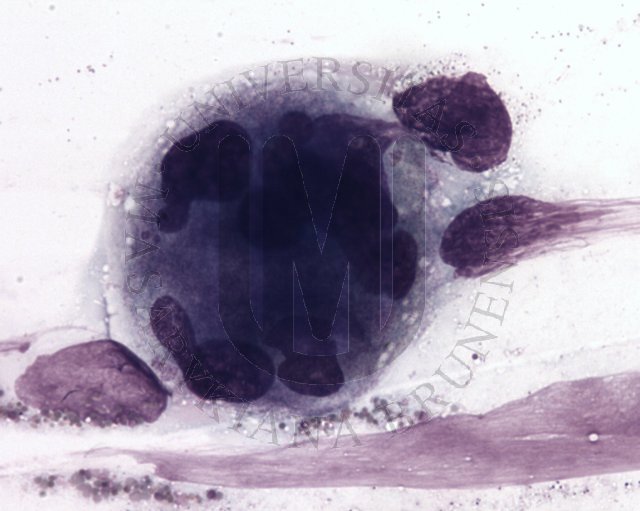 Megaloblastic haematopoiesis- BM