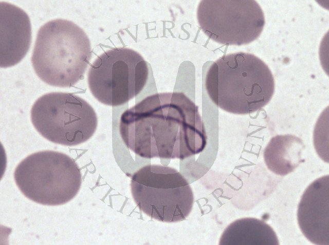 Megaloblastic haematopoiesis- PB