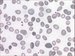 There are macrocytes and also characteristic oval macrocytes in peripheral blood smear. There is also some degree of anisocytosis and poikilocytosis in this rather severe case, including the presence of tear-drop poikilocytes, fragments.  / V ntru perifern krve jsou makrocyty a charakteristick makroovalocyty. U tohoto spe zvanjho ppadu je ptomen i jist stup anicytzy, poikilocytzy, vetn ptomnosti slzikovitch poikilocyt, fragment.  