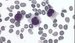 In this case of hairy cell leukemia smears shows unusually large tumour cells (usually medium-size), with irregular nucleus shape and/or cleft . Chromatin of the nucleus is spongy, less clumped than that of a normal lymphocyte.    / V tomto ppad vlasatobunn leukmie ntry ukazuj neobvykle velk ndorov buky (obvykle stedn velikosti). Jadern chromatin je provit, mn kondenzovan neli tomu je u normlnho lymfocytu. 