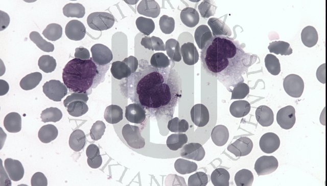 Hairy cell leukaemia- BM