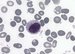 Another example of hairy cell - oval nucleus, moderate mature chromatin, abundant weakly basophilic cytoplasm with few vacuoles, few inclusions and irregular margins with projections in all circumference of the cell.  / Jin pklad vlasat buky - ovln jdro, stedn zral chromatin, bohat slab basofiln cytoplazma s nkolika vakuolami, nkolika inkluzemi a nepravidelnm ohranienm s vbky po celom obvodu buky.   