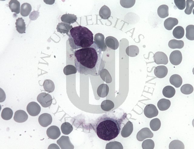 Hairy cell leukaemia- BM