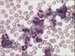 Peripheral blood smear shows numerous granulocytes with predominate segmented neutrophils and myelocytes (four of them are in the picture).  / Ntry perifern krve ukazuj poetn granulocyty s predominanc segmentovanch neutrofil a myelocyt (tyi na obrzku). 