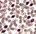 Lymphoma cell with short polar villi in peripheral blood smear (fresh capillary blood smear).  Cells are larger than normal small lymphocyte with round to oval nucleus. There are not seen clear nucleoli here.  / Lymfomov buky s krtkmi polrnmi vbky v ntru perifern krve (ntr erstv kapilrn krve). Buky jsou vt ne normln mal lymfocyt, s kulatm a ovlnm jdrem. Jasn jadrka zde nejsou patrn. 