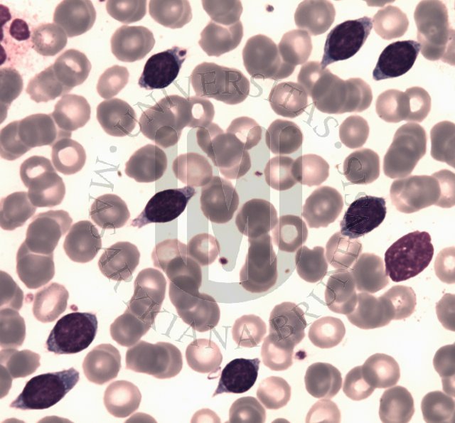 Splenic marginal zone B- cell lymphoma