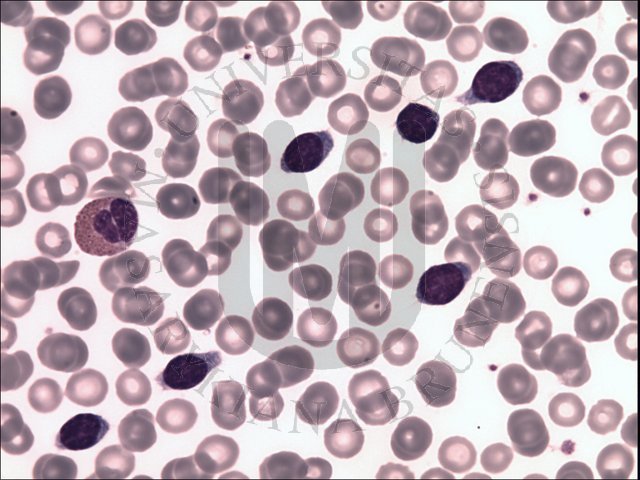 Splenic marginal zone B- cell  lymphoma