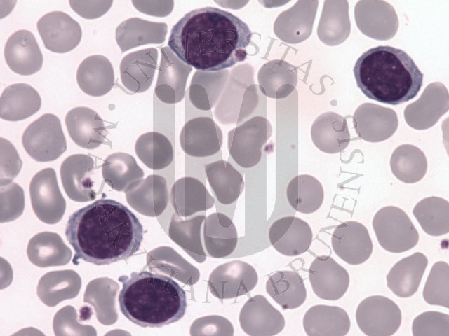 Splenic marginal zone B-cell lymphoma