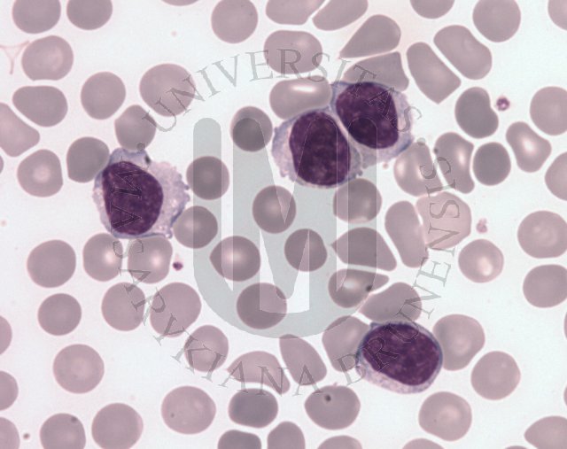 Splenic marginal zone B- cell lymphoma 