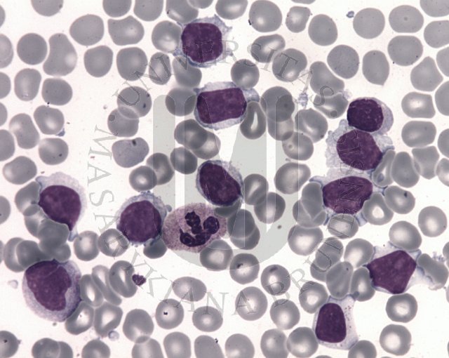 Splenic marginal zone B- cell lymphoma 