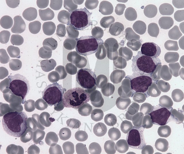 Splenic marginal zone B-cell lymphoma