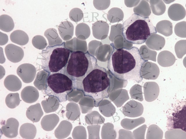 Splenic marginal zone B- cell lymphoma