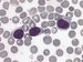 Three lymphoma cells with round or oval nuclei and small nucleoli. Cytoplasmic blebs are evident especially in the cell at the upper right.  / Ti lymfomov buky s kulatmi nebo ovlnmi jdry a malmi jadrky. Cytoplazmatick "blebs" jsou zejm zejmna v buce nahoe vpravo. 