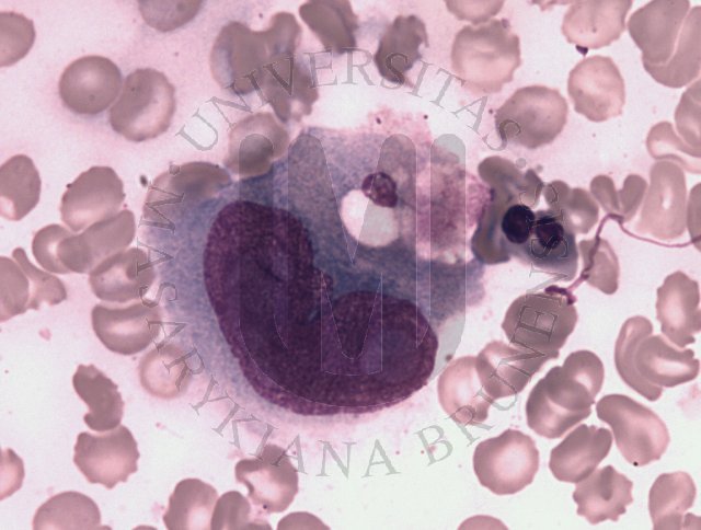 Anaplastic large cell lymphoma - ALK negative