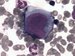 The large cell or one can say almost giant one tumour cell in blood marrow in ALCL and ALK negative T- cell lymphoma. Kidney shape of nucleus is rather typical as also they are multiple nuclei. Cytoplasm is abundant when one compares it with immature nucleus chromatin pattern.  / Velk a lze ci a obrovsk ndorov buka v kostn den u ALCL ALK negativnho T-bunnho lymfomu. Ledvinovit tvar jdra je spe typick podobn jako mnohoetn jadrka. Cytoplazma je bohat pi porovnn s nezralm vzhledem jadernho chromatinu.