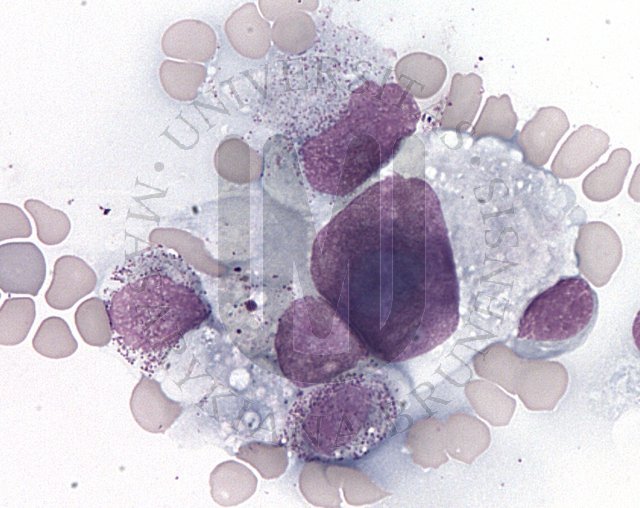 Anaplastic large cell lymphoma - ALK negative