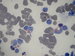 Medulloblastomoa cells in BM with positive AP (acid phosphatase) staining, (Similar finding to  neuroblastoma) / meduloblastomov buky v kostn deni s positivn reakc na kyselou fosfatzu, stejn jako u neuroblastomu