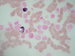 negative MPOX in medulloblastoma cells, positive reaction in granulocytes only / MPOX je v bukch medulloblastomu negativn, na fotografii jsou posotovn jen granulocyty