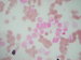 negative MPOX in medulloblastoma cells, positive reaction in granulocytes only / MPOX je v bukch medulloblastomu negativn, na fotografii jsou posotovn jen granulocyty