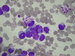 A cluster of medulloblastoma cells of unequal size with nuclear chromatin of a coarse structure In some of the cells there are nucleoli, irregular cell  membrane , with incisions, occasionally with incipient lobulisation.Cytoplasm basophilic, locally with slightly acidophilic areas. Cytoplasm is markedly vacuolised, in some of the cells  there are vacuoles also in the nuclei, / trs meduloblastomovch bunk nestejn verlikosti, chromatin jadern je hrubji strukturovn, v nkterch bukch patrn jadrka, membrna jadern nepravideln, se zezy, nkdy s nznakem lobulizace. Cytoplasma basofiln, msty  s lehce acidofilnmi okrsky, cytoplasma m npadnou vakuolizac, kter je v nkterch bukch i v jde.