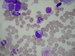 medulloblastoma cells in BM, mostly with intracelullar vacuoles In the centre there is a tumor cell with a large vacuole. Few nuclear shadows seen / buky medulloblastomu v KD, vtiniou s vakuolami, centrln ndorov buka s velkou vakuolou, nkolik jadernch stn,