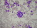 Centrally a medulloblastoma cells rosette, with low magnification nucleoli not visible, evident vacuolisation in nuclei as well as in cytoplasm. too. / centrln roseta meduloblastomovch bunk, pi pehlednm zvten nejsou patrn jadrka,v nkterch bukch jsou patrn vakuoly v jde i v cytoplasm.