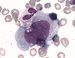 Two closely pressed malignant lymphoma cells with ex-centric nucleus, reticular chromatin pattern, few nucleoli and abundant pale basophilic finely vacuolized cytoplasm.  / Dv tsn pititn malign lymfomov buky s excentrickm jdrem, sovitm vzorkem jadernho chromatinu, nkolika jadrky a bohatou svtle bazofiln jemn vakuolizovanou cytoplazmou. 