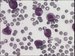 The main feature of this type acute myeloblastic leukaemia is bi-lobed nuclear shape and presence of dust-like reddish granules in cytoplasm. Some tumour cells can be even agranular. Leukocytosis is usual when one compares this type with classic hyper-granular form.   / Hlavnm rysem tohoto typu akutn myeloblastick leukmie je bilobrn tvar jdra a ptomnost prachovch naervenalch granul v cytoplazm. Nkter ndorov buky mohou bt dokonce agranulrn. Leukocytza je obvykla v porovnn s klasickou hypergranulrn variantou. 
