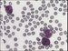 Tumour cell with bi-lobar nucleus, clear nucleoli in every nuclear part, some (upper left) or no (lower right) cytoplasmic granulation.  / Ndorov buky s bilobrnm jdrem, jasnmi jadrky v kad sti jdra, njakou (vlevo nahoe) nebo dnou (vpravo dole) cytoplazmatickou granulac. 