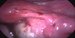 Uterus, right ovary with endometrial cyst and dilated ampullar part of the right uterine tube after dye instillation. / Děloha, pravý zvětšený vaječník a rozšířená ampulární část pravého vejcovodu po instilace patent blau při chromopertubaci.