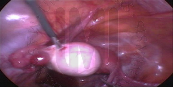 a genitális szemölcsök cauterizációja chirurgitron segítségével