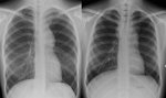 Figure 6: chest X-ray