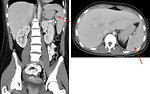 Figure 8: abdominal CT scan with spleen involvement