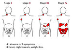 Figure 16: Ann Arbor staging system for Hodgkin lymphoma