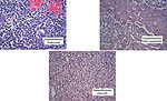 Figure 14: Histology types of hepatoblastoma