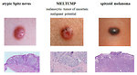 Figure 4: Spitz nevus and its different forms