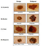 Figure 6: ABCD criteria of malignant skin melanoma
