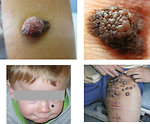 Figure 7: Clinical examination of melanoma (KDO FN Brno)