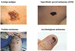 Figure 9: Histology types of melanoma