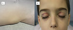 Figure 1: Metastasis of neuroblastoma: (A) skin, (B) orbits – „racoon eyes“ 