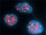 Figure 5: NMYC amplification in neuroblastoma; laboratory method – FISH (fluorescent in situ hybridisation). Normally we should see 2 green control signals (centrosomic probe on chromosome 2) and 2 pink signals (NMYC).