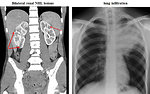 Figure 4: NHL infiltration of non-lymphatic organs in 17-year-old boy (KDO FN Brno)