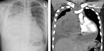 Figure 9: UZ and CT of mediastinal T NHL with pleural and pericardial effusion (KDO FN Brno)